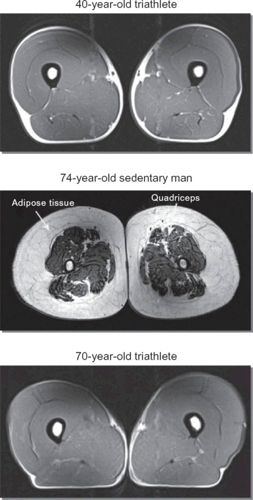 Athlete vs. Couch Potato Quadriceps MRI Scan 